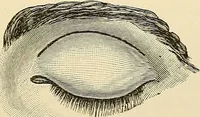 An illustration from Surgical technic; a text-book on operative surgery / by Fr. von Esmarch ... and E. Kowalzig ... translated by Professor Ludwig H. Grau ... and Willam N. Sullivan ... edited by Nicholas Senn ... With fourteen hundred and ninety-seven illustrations and fifteen colored plates. (1901)