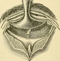 An illustration from Surgical technic; a text-book on operative surgery / by Fr. von Esmarch ... and E. Kowalzig ... translated by Professor Ludwig H. Grau ... and Willam N. Sullivan ... edited by Nicholas Senn ... With fourteen hundred and ninety-seven illustrations and fifteen colored plates. (1901)