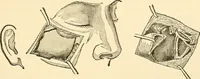 An illustration from Surgical technic; a text-book on operative surgery / by Fr. von Esmarch ... and E. Kowalzig ... translated by Professor Ludwig H. Grau ... and Willam N. Sullivan ... edited by Nicholas Senn ... With fourteen hundred and ninety-seven illustrations and fifteen colored plates. (1901)