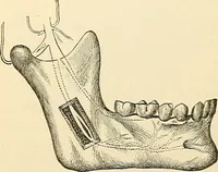 An illustration from Surgical technic; a text-book on operative surgery / by Fr. von Esmarch ... and E. Kowalzig ... translated by Professor Ludwig H. Grau ... and Willam N. Sullivan ... edited by Nicholas Senn ... With fourteen hundred and ninety-seven illustrations and fifteen colored plates. (1901)