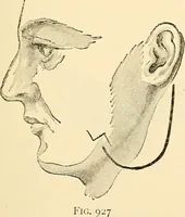 An illustration from Surgical technic; a text-book on operative surgery / by Fr. von Esmarch ... and E. Kowalzig ... translated by Professor Ludwig H. Grau ... and Willam N. Sullivan ... edited by Nicholas Senn ... With fourteen hundred and ninety-seven illustrations and fifteen colored plates. (1901)