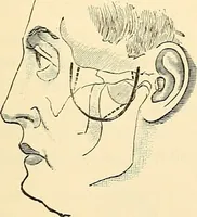 An illustration from Surgical technic; a text-book on operative surgery / by Fr. von Esmarch ... and E. Kowalzig ... translated by Professor Ludwig H. Grau ... and Willam N. Sullivan ... edited by Nicholas Senn ... With fourteen hundred and ninety-seven illustrations and fifteen colored plates. (1901)