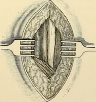 An illustration from Surgical technic; a text-book on operative surgery / by Fr. von Esmarch ... and E. Kowalzig ... translated by Professor Ludwig H. Grau ... and Willam N. Sullivan ... edited by Nicholas Senn ... With fourteen hundred and ninety-seven illustrations and fifteen colored plates. (1901)