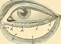 An illustration from Surgical technic; a text-book on operative surgery / by Fr. von Esmarch ... and E. Kowalzig ... translated by Professor Ludwig H. Grau ... and Willam N. Sullivan ... edited by Nicholas Senn ... With fourteen hundred and ninety-seven illustrations and fifteen colored plates. (1901)