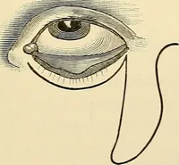 An illustration from Surgical technic; a text-book on operative surgery / by Fr. von Esmarch ... and E. Kowalzig ... translated by Professor Ludwig H. Grau ... and Willam N. Sullivan ... edited by Nicholas Senn ... With fourteen hundred and ninety-seven illustrations and fifteen colored plates. (1901)