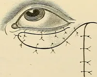 An illustration from Surgical technic; a text-book on operative surgery / by Fr. von Esmarch ... and E. Kowalzig ... translated by Professor Ludwig H. Grau ... and Willam N. Sullivan ... edited by Nicholas Senn ... With fourteen hundred and ninety-seven illustrations and fifteen colored plates. (1901)