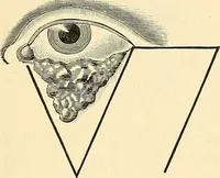 An illustration from Surgical technic; a text-book on operative surgery / by Fr. von Esmarch ... and E. Kowalzig ... translated by Professor Ludwig H. Grau ... and Willam N. Sullivan ... edited by Nicholas Senn ... With fourteen hundred and ninety-seven illustrations and fifteen colored plates. (1901)