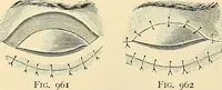 An illustration from Surgical technic; a text-book on operative surgery / by Fr. von Esmarch ... and E. Kowalzig ... translated by Professor Ludwig H. Grau ... and Willam N. Sullivan ... edited by Nicholas Senn ... With fourteen hundred and ninety-seven illustrations and fifteen colored plates. (1901)