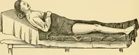 An illustration from Surgical technic; a text-book on operative surgery / by Fr. von Esmarch ... and E. Kowalzig ... translated by Professor Ludwig H. Grau ... and Willam N. Sullivan ... edited by Nicholas Senn ... With fourteen hundred and ninety-seven illustrations and fifteen colored plates. (1901)