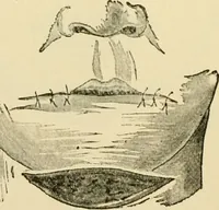 An illustration from Surgical technic; a text-book on operative surgery / by Fr. von Esmarch ... and E. Kowalzig ... translated by Professor Ludwig H. Grau ... and Willam N. Sullivan ... edited by Nicholas Senn ... With fourteen hundred and ninety-seven illustrations and fifteen colored plates. (1901)