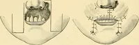 An illustration from Surgical technic; a text-book on operative surgery / by Fr. von Esmarch ... and E. Kowalzig ... translated by Professor Ludwig H. Grau ... and Willam N. Sullivan ... edited by Nicholas Senn ... With fourteen hundred and ninety-seven illustrations and fifteen colored plates. (1901)