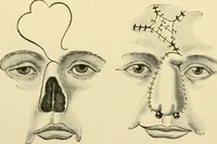 An illustration from Surgical technic; a text-book on operative surgery / by Fr. von Esmarch ... and E. Kowalzig ... translated by Professor Ludwig H. Grau ... and Willam N. Sullivan ... edited by Nicholas Senn ... With fourteen hundred and ninety-seven illustrations and fifteen colored plates. (1901)