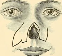 An illustration from Surgical technic; a text-book on operative surgery / by Fr. von Esmarch ... and E. Kowalzig ... translated by Professor Ludwig H. Grau ... and Willam N. Sullivan ... edited by Nicholas Senn ... With fourteen hundred and ninety-seven illustrations and fifteen colored plates. (1901)