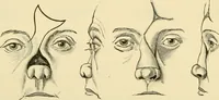 An illustration from Surgical technic; a text-book on operative surgery / by Fr. von Esmarch ... and E. Kowalzig ... translated by Professor Ludwig H. Grau ... and Willam N. Sullivan ... edited by Nicholas Senn ... With fourteen hundred and ninety-seven illustrations and fifteen colored plates. (1901)