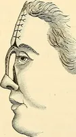 An illustration from Surgical technic; a text-book on operative surgery / by Fr. von Esmarch ... and E. Kowalzig ... translated by Professor Ludwig H. Grau ... and Willam N. Sullivan ... edited by Nicholas Senn ... With fourteen hundred and ninety-seven illustrations and fifteen colored plates. (1901)