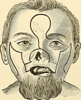 An illustration from Surgical technic; a text-book on operative surgery / by Fr. von Esmarch ... and E. Kowalzig ... translated by Professor Ludwig H. Grau ... and Willam N. Sullivan ... edited by Nicholas Senn ... With fourteen hundred and ninety-seven illustrations and fifteen colored plates. (1901)