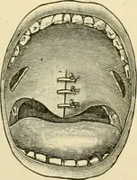 An illustration from Surgical technic; a text-book on operative surgery / by Fr. von Esmarch ... and E. Kowalzig ... translated by Professor Ludwig H. Grau ... and Willam N. Sullivan ... edited by Nicholas Senn ... With fourteen hundred and ninety-seven illustrations and fifteen colored plates. (1901)