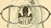 An illustration from Surgical technic; a text-book on operative surgery / by Fr. von Esmarch ... and E. Kowalzig ... translated by Professor Ludwig H. Grau ... and Willam N. Sullivan ... edited by Nicholas Senn ... With fourteen hundred and ninety-seven illustrations and fifteen colored plates. (1901)