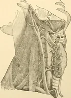 An illustration from Surgical technic; a text-book on operative surgery / by Fr. von Esmarch ... and E. Kowalzig ... translated by Professor Ludwig H. Grau ... and Willam N. Sullivan ... edited by Nicholas Senn ... With fourteen hundred and ninety-seven illustrations and fifteen colored plates. (1901)