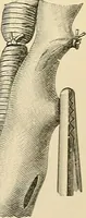 An illustration from Surgical technic; a text-book on operative surgery / by Fr. von Esmarch ... and E. Kowalzig ... translated by Professor Ludwig H. Grau ... and Willam N. Sullivan ... edited by Nicholas Senn ... With fourteen hundred and ninety-seven illustrations and fifteen colored plates. (1901)