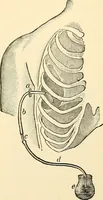 An illustration from Surgical technic; a text-book on operative surgery / by Fr. von Esmarch ... and E. Kowalzig ... translated by Professor Ludwig H. Grau ... and Willam N. Sullivan ... edited by Nicholas Senn ... With fourteen hundred and ninety-seven illustrations and fifteen colored plates. (1901)