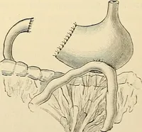 An illustration from Surgical technic; a text-book on operative surgery / by Fr. von Esmarch ... and E. Kowalzig ... translated by Professor Ludwig H. Grau ... and Willam N. Sullivan ... edited by Nicholas Senn ... With fourteen hundred and ninety-seven illustrations and fifteen colored plates. (1901)