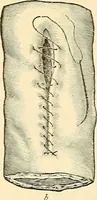 An illustration from Surgical technic; a text-book on operative surgery / by Fr. von Esmarch ... and E. Kowalzig ... translated by Professor Ludwig H. Grau ... and Willam N. Sullivan ... edited by Nicholas Senn ... With fourteen hundred and ninety-seven illustrations and fifteen colored plates. (1901)