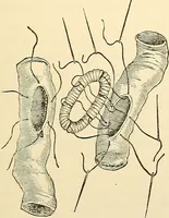 An illustration from Surgical technic; a text-book on operative surgery / by Fr. von Esmarch ... and E. Kowalzig ... translated by Professor Ludwig H. Grau ... and Willam N. Sullivan ... edited by Nicholas Senn ... With fourteen hundred and ninety-seven illustrations and fifteen colored plates. (1901)