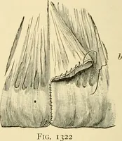 An illustration from Surgical technic; a text-book on operative surgery / by Fr. von Esmarch ... and E. Kowalzig ... translated by Professor Ludwig H. Grau ... and Willam N. Sullivan ... edited by Nicholas Senn ... With fourteen hundred and ninety-seven illustrations and fifteen colored plates. (1901)