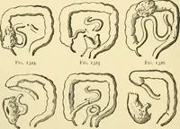 An illustration from Surgical technic; a text-book on operative surgery / by Fr. von Esmarch ... and E. Kowalzig ... translated by Professor Ludwig H. Grau ... and Willam N. Sullivan ... edited by Nicholas Senn ... With fourteen hundred and ninety-seven illustrations and fifteen colored plates. (1901)