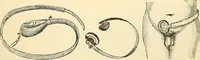An illustration from Surgical technic; a text-book on operative surgery / by Fr. von Esmarch ... and E. Kowalzig ... translated by Professor Ludwig H. Grau ... and Willam N. Sullivan ... edited by Nicholas Senn ... With fourteen hundred and ninety-seven illustrations and fifteen colored plates. (1901)