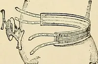 An illustration from Surgical technic; a text-book on operative surgery / by Fr. von Esmarch ... and E. Kowalzig ... translated by Professor Ludwig H. Grau ... and Willam N. Sullivan ... edited by Nicholas Senn ... With fourteen hundred and ninety-seven illustrations and fifteen colored plates. (1901)