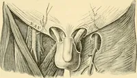 An illustration from Surgical technic; a text-book on operative surgery / by Fr. von Esmarch ... and E. Kowalzig ... translated by Professor Ludwig H. Grau ... and Willam N. Sullivan ... edited by Nicholas Senn ... With fourteen hundred and ninety-seven illustrations and fifteen colored plates. (1901)