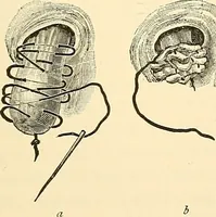 An illustration from Surgical technic; a text-book on operative surgery / by Fr. von Esmarch ... and E. Kowalzig ... translated by Professor Ludwig H. Grau ... and Willam N. Sullivan ... edited by Nicholas Senn ... With fourteen hundred and ninety-seven illustrations and fifteen colored plates. (1901)