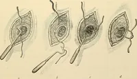 An illustration from Surgical technic; a text-book on operative surgery / by Fr. von Esmarch ... and E. Kowalzig ... translated by Professor Ludwig H. Grau ... and Willam N. Sullivan ... edited by Nicholas Senn ... With fourteen hundred and ninety-seven illustrations and fifteen colored plates. (1901)