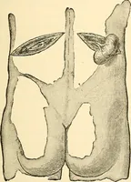 An illustration from Surgical technic; a text-book on operative surgery / by Fr. von Esmarch ... and E. Kowalzig ... translated by Professor Ludwig H. Grau ... and Willam N. Sullivan ... edited by Nicholas Senn ... With fourteen hundred and ninety-seven illustrations and fifteen colored plates. (1901)