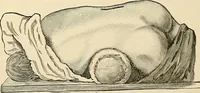 An illustration from Surgical technic; a text-book on operative surgery / by Fr. von Esmarch ... and E. Kowalzig ... translated by Professor Ludwig H. Grau ... and Willam N. Sullivan ... edited by Nicholas Senn ... With fourteen hundred and ninety-seven illustrations and fifteen colored plates. (1901)