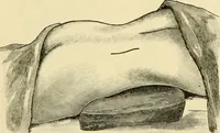 An illustration from Surgical technic; a text-book on operative surgery / by Fr. von Esmarch ... and E. Kowalzig ... translated by Professor Ludwig H. Grau ... and Willam N. Sullivan ... edited by Nicholas Senn ... With fourteen hundred and ninety-seven illustrations and fifteen colored plates. (1901)