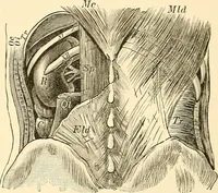 An illustration from Surgical technic; a text-book on operative surgery / by Fr. von Esmarch ... and E. Kowalzig ... translated by Professor Ludwig H. Grau ... and Willam N. Sullivan ... edited by Nicholas Senn ... With fourteen hundred and ninety-seven illustrations and fifteen colored plates. (1901)