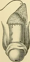 An illustration from Surgical technic; a text-book on operative surgery / by Fr. von Esmarch ... and E. Kowalzig ... translated by Professor Ludwig H. Grau ... and Willam N. Sullivan ... edited by Nicholas Senn ... With fourteen hundred and ninety-seven illustrations and fifteen colored plates. (1901)