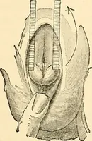 An illustration from Surgical technic; a text-book on operative surgery / by Fr. von Esmarch ... and E. Kowalzig ... translated by Professor Ludwig H. Grau ... and Willam N. Sullivan ... edited by Nicholas Senn ... With fourteen hundred and ninety-seven illustrations and fifteen colored plates. (1901)