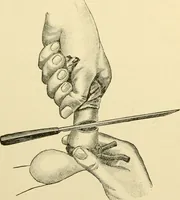 An illustration from Surgical technic; a text-book on operative surgery / by Fr. von Esmarch ... and E. Kowalzig ... translated by Professor Ludwig H. Grau ... and Willam N. Sullivan ... edited by Nicholas Senn ... With fourteen hundred and ninety-seven illustrations and fifteen colored plates. (1901)