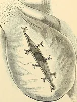 An illustration from Surgical technic; a text-book on operative surgery / by Fr. von Esmarch ... and E. Kowalzig ... translated by Professor Ludwig H. Grau ... and Willam N. Sullivan ... edited by Nicholas Senn ... With fourteen hundred and ninety-seven illustrations and fifteen colored plates. (1901)