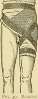 An illustration from Surgical technic; a text-book on operative surgery / by Fr. von Esmarch ... and E. Kowalzig ... translated by Professor Ludwig H. Grau ... and Willam N. Sullivan ... edited by Nicholas Senn ... With fourteen hundred and ninety-seven illustrations and fifteen colored plates. (1901)