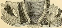 An illustration from Surgical technic; a text-book on operative surgery / by Fr. von Esmarch ... and E. Kowalzig ... translated by Professor Ludwig H. Grau ... and Willam N. Sullivan ... edited by Nicholas Senn ... With fourteen hundred and ninety-seven illustrations and fifteen colored plates. (1901)