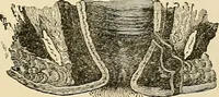 An illustration from Surgical technic; a text-book on operative surgery / by Fr. von Esmarch ... and E. Kowalzig ... translated by Professor Ludwig H. Grau ... and Willam N. Sullivan ... edited by Nicholas Senn ... With fourteen hundred and ninety-seven illustrations and fifteen colored plates. (1901)
