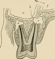 An illustration from The practice of dental medicine / By George F. Eames. Containing thirty-eight engravings and three colored plates. (1899)