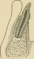 An illustration from The practice of dental medicine / By George F. Eames. Containing thirty-eight engravings and three colored plates. (1899)