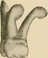 An illustration from The practice of dental medicine / By George F. Eames. Containing thirty-eight engravings and three colored plates. (1899)