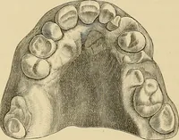 An illustration from The practice of dental medicine / By George F. Eames. Containing thirty-eight engravings and three colored plates. (1899)
